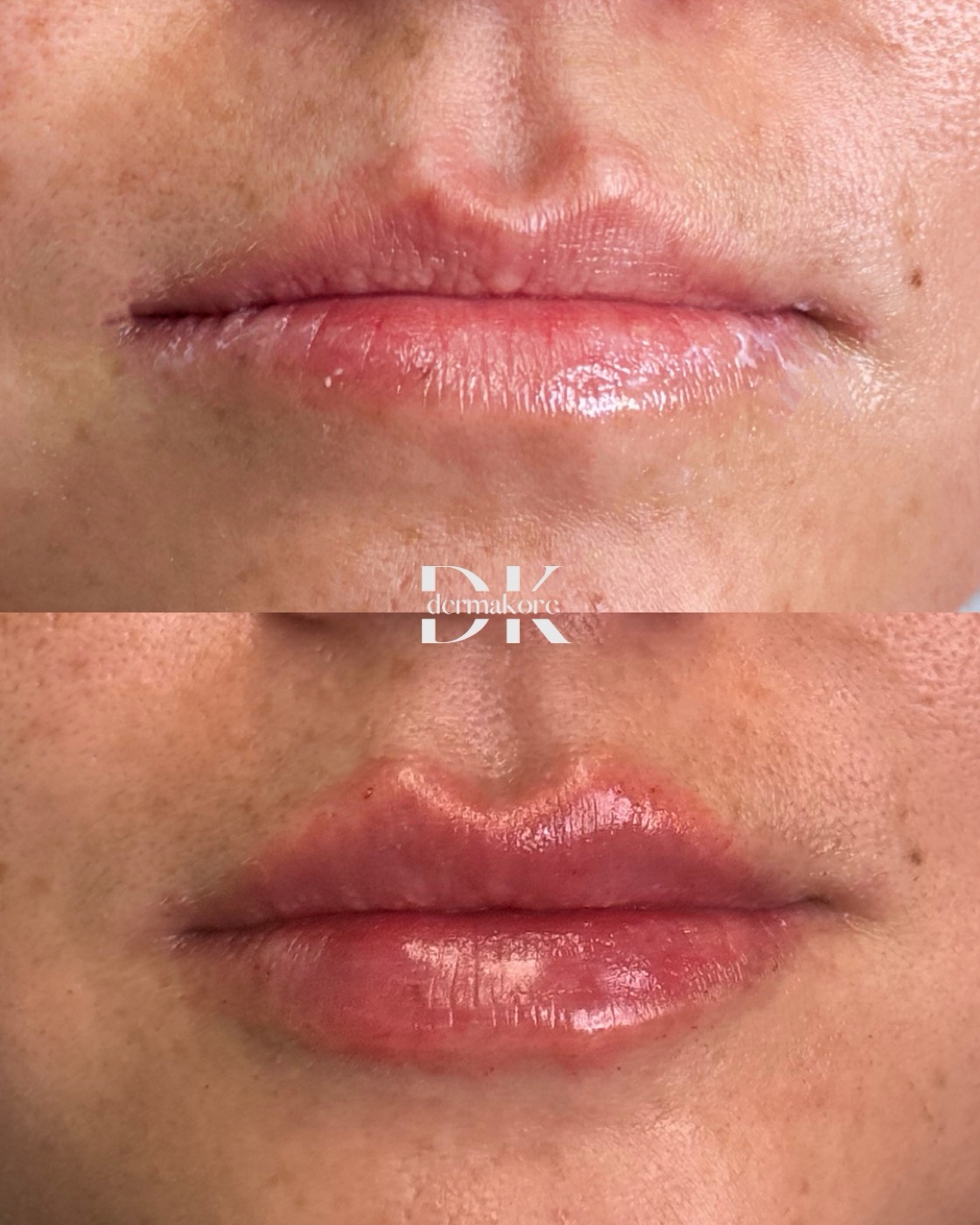 Antes y después de labios en Dermakore