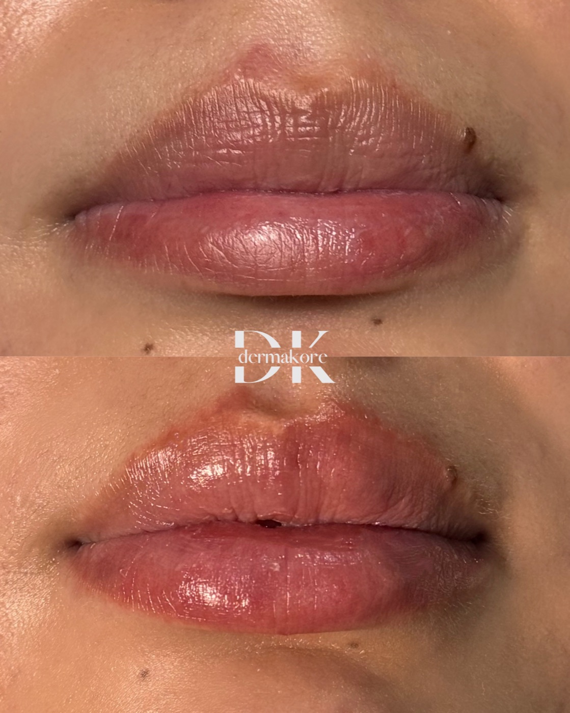 Resultado natural de labios en Dermakore