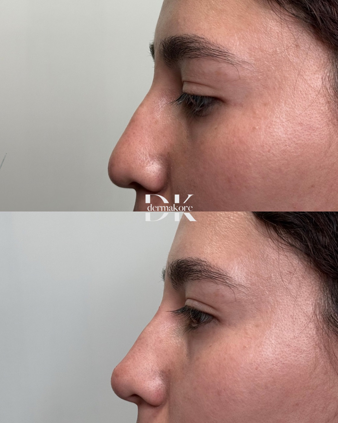 Antes y después de perfil facial en Dermakore
