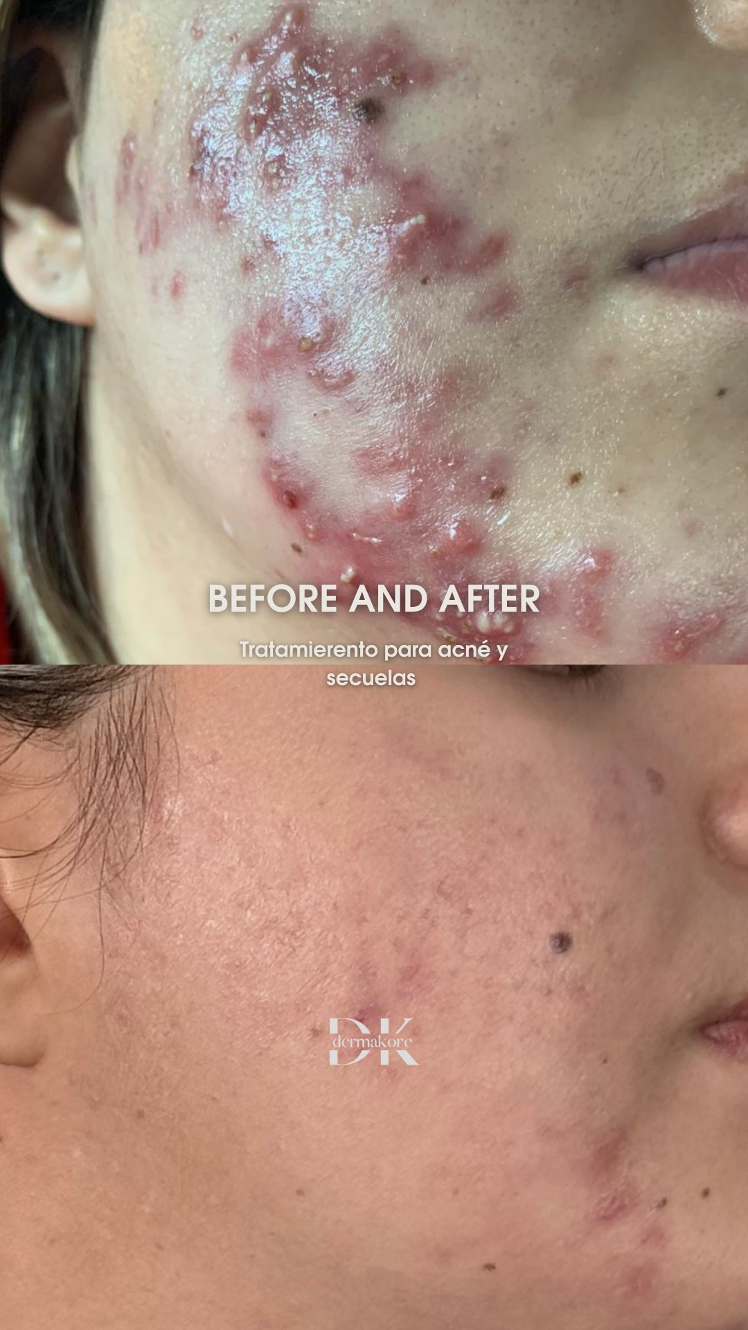 Antes y después de tratamiento de acné en Dermakore