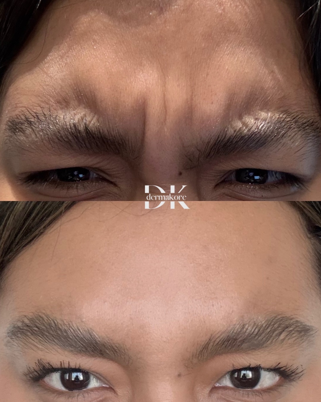 Antes y después de la zona de los ojos en Dermakore