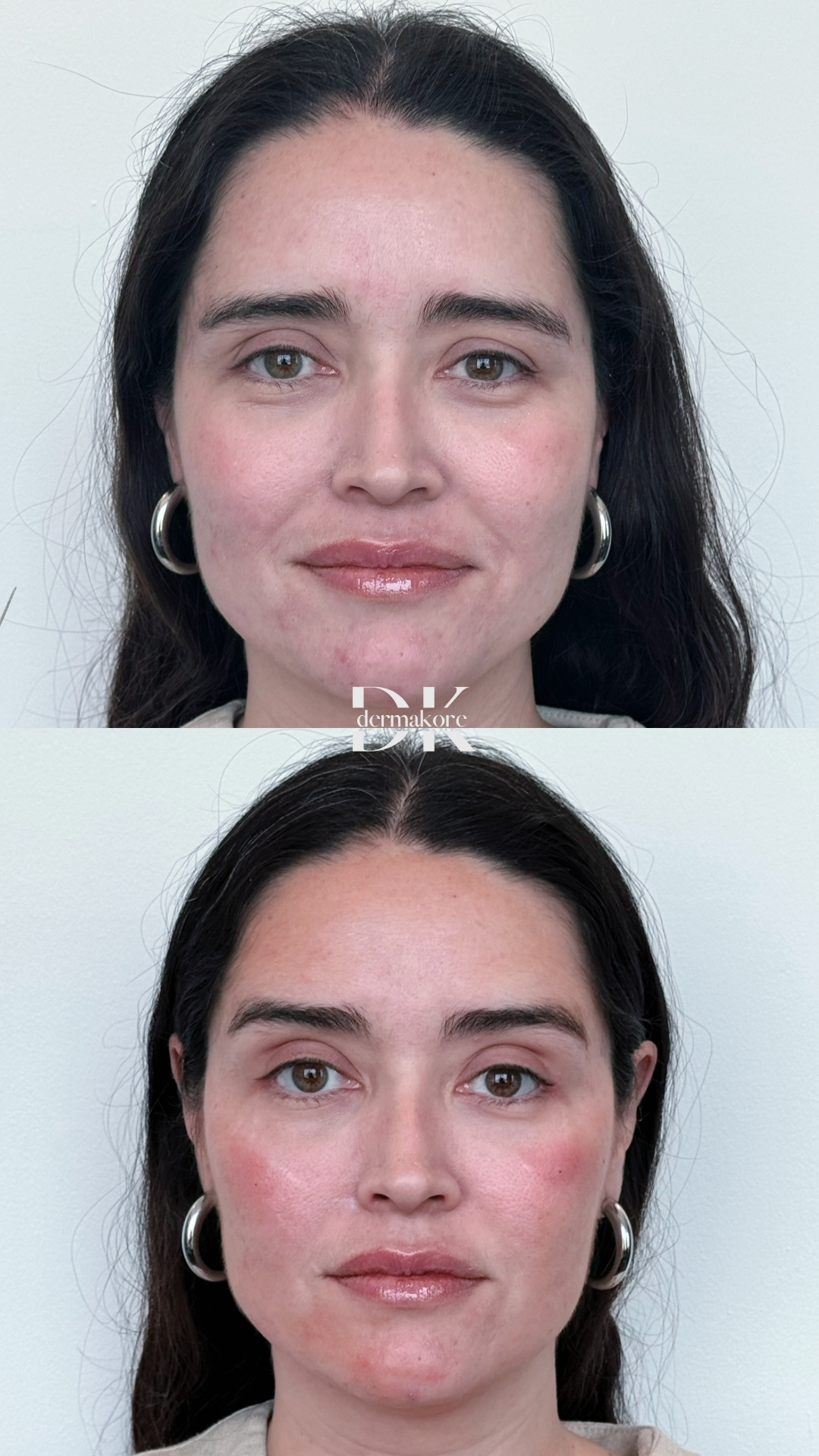 Comparación de resultado facial en Dermakore