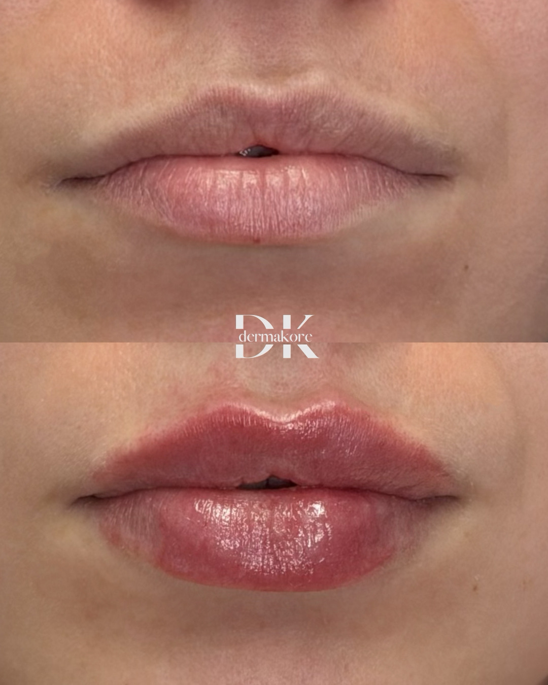 Antes y después de labios, vista frontal
