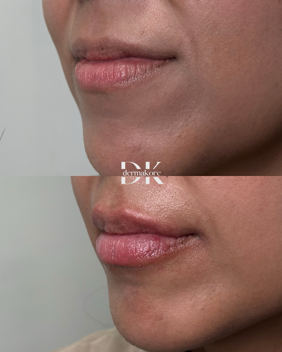 Antes y después de labios, vista lateral
